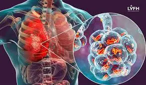 Ung Thư Phổi Giai Đoạn Cuối Mang Đột Biến Gen ALK:  Bệnh Nhân Vượt Qua Rào Cản Sống Sót 5 Năm và tai kubet
